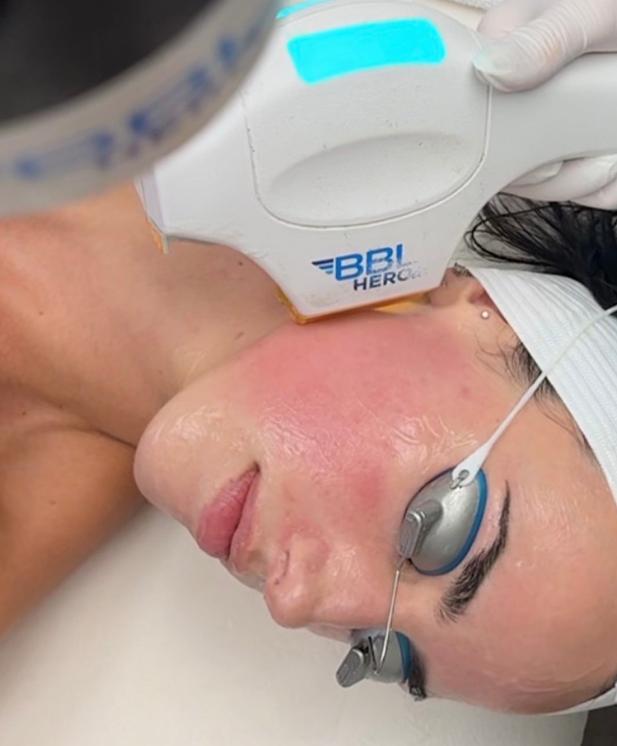 Facial treatment using a skin care device.
