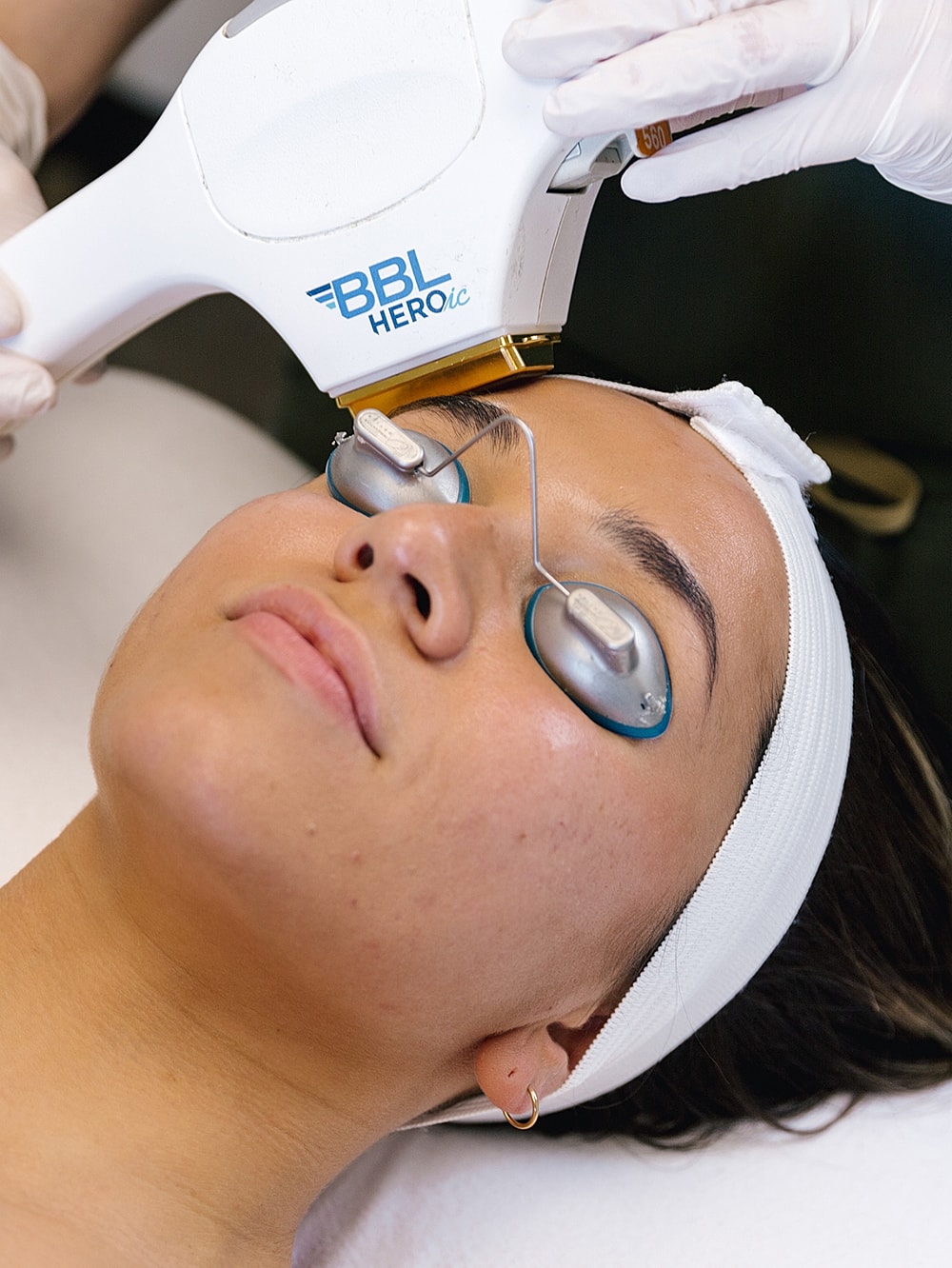 BBL treatment on a Salt Lake City med spa model's face.