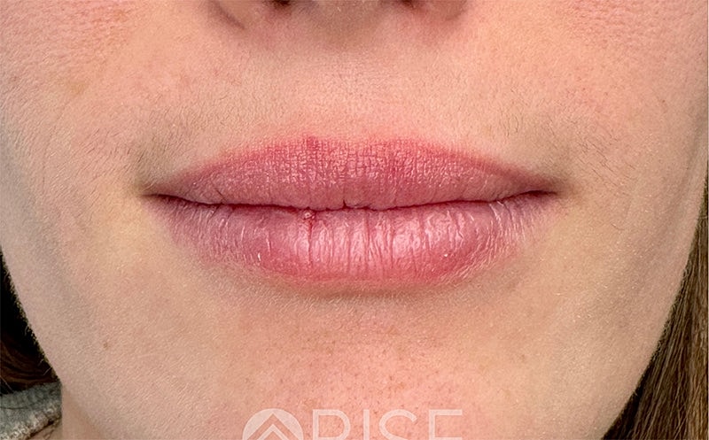 Lip Filler Before & After