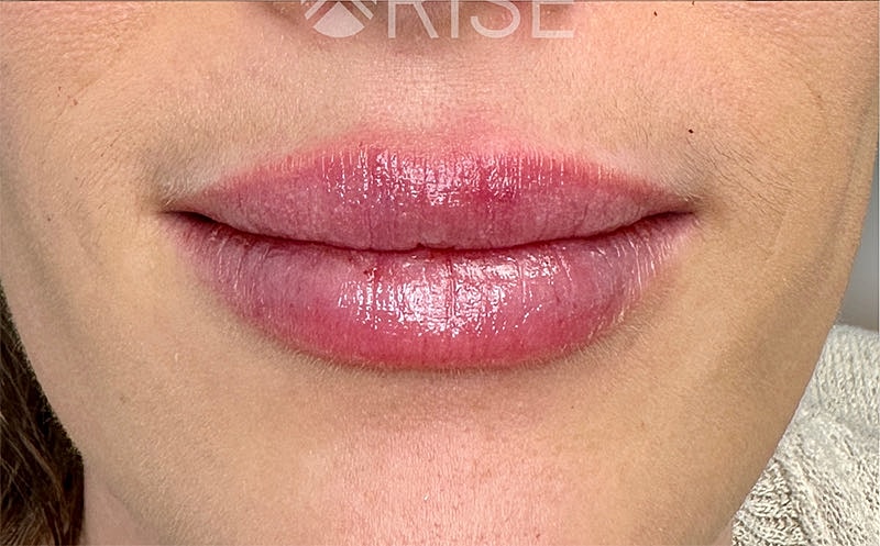 Lip Filler Before & After