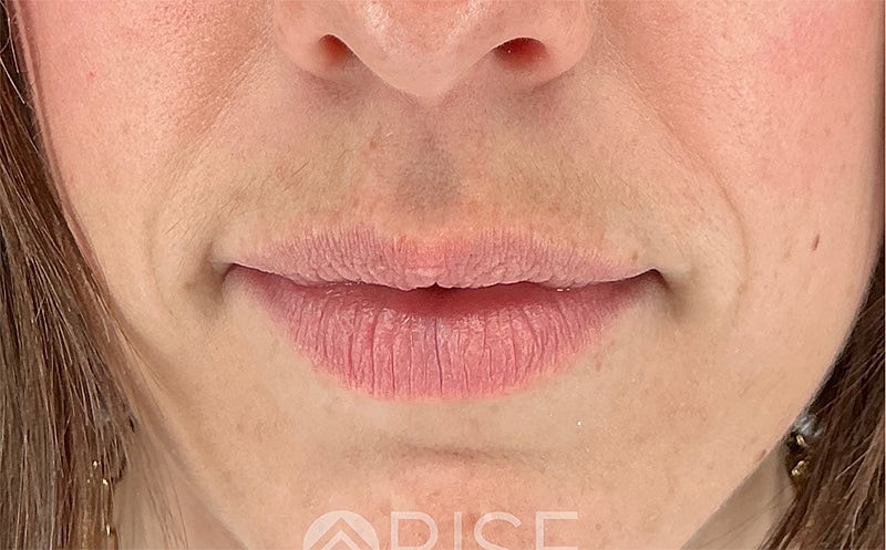 Lip Filler Before & After