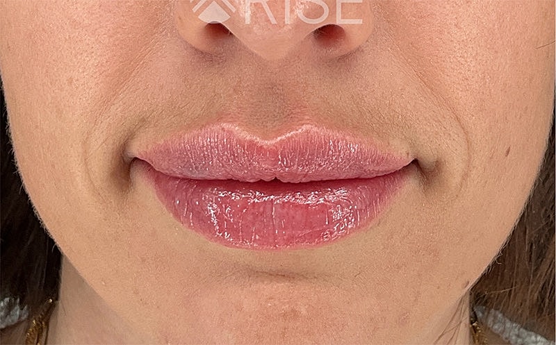 Lip Filler Before & After