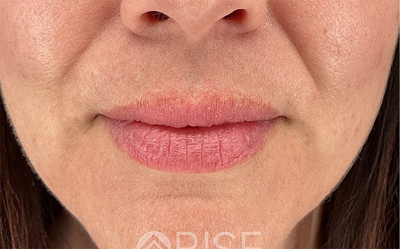 Lip Filler Before & After