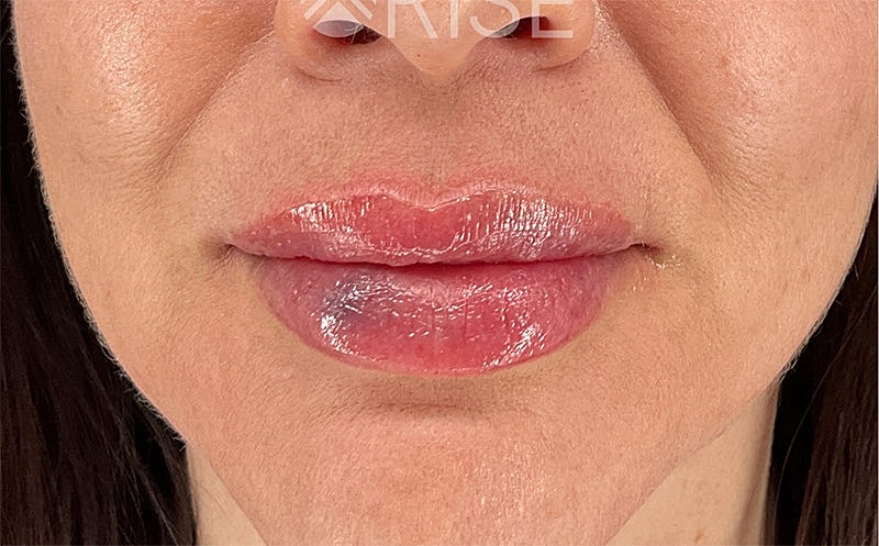 Lip Filler Before & After
