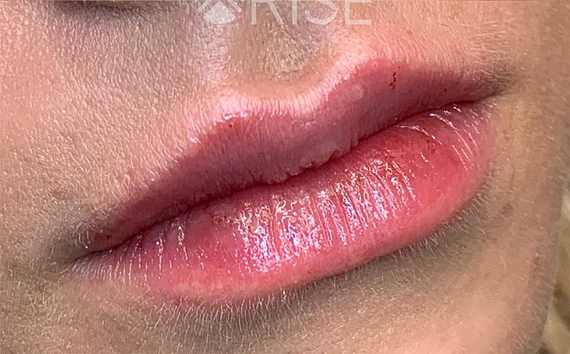 Lip Filler Before & After