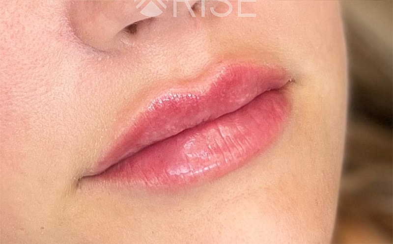 Lip Filler Before & After