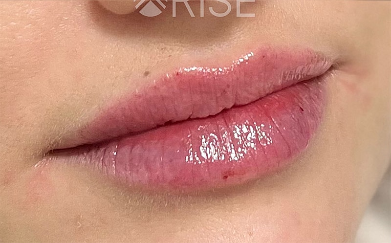 Lip Filler Before & After