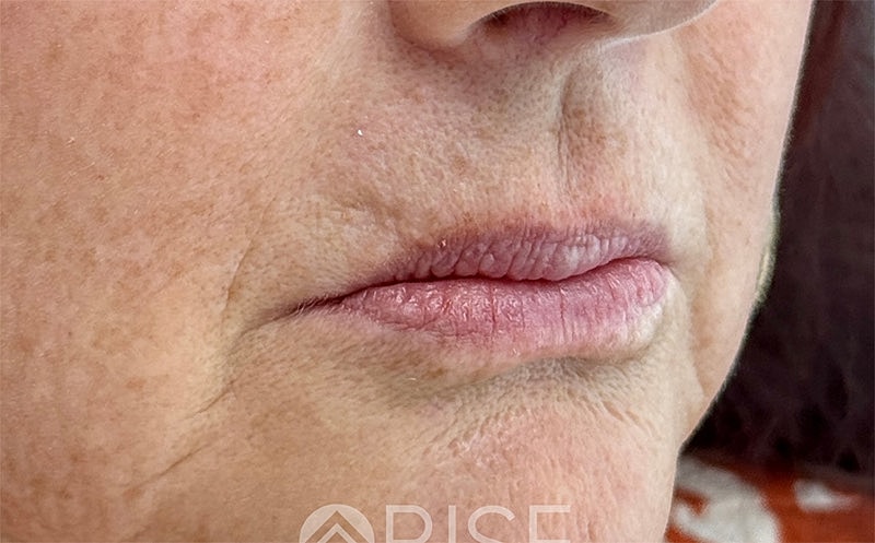 Lip Filler Before & After