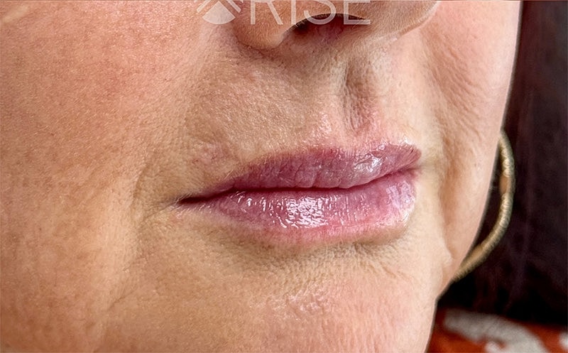 Lip Filler Before & After