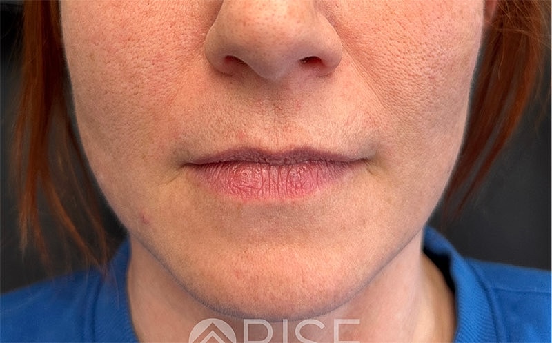 Lip Filler Before & After