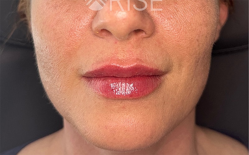 Lip Filler Before & After