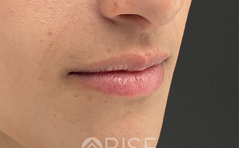Lip Filler Before & After