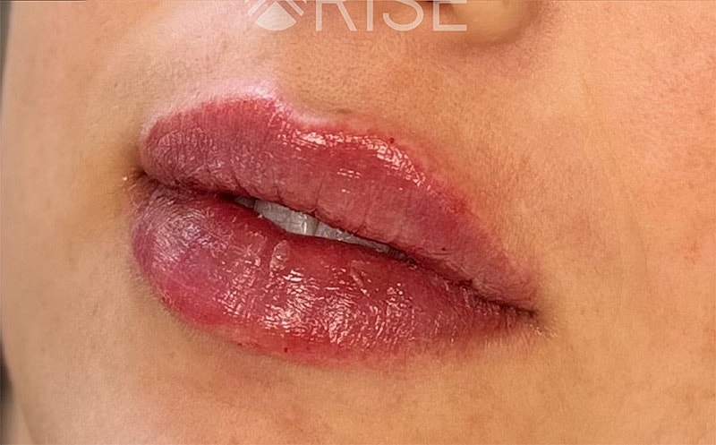 Lip Filler Before & After