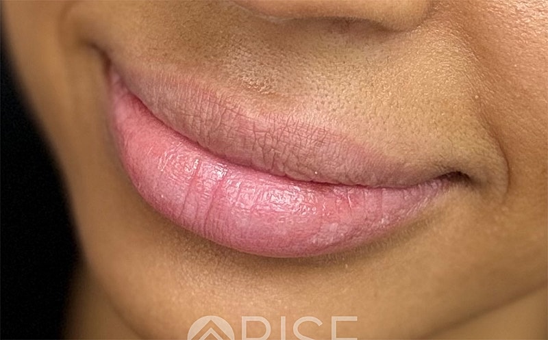 Lip Filler Before & After