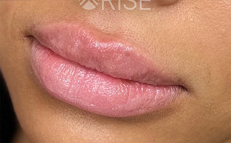 Lip Filler Before & After