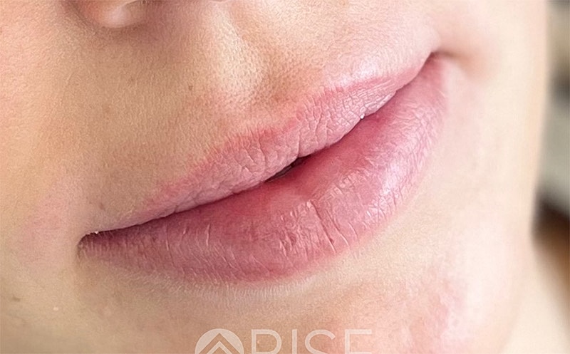 Lip Filler Before & After