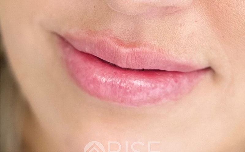 Lip Filler Before & After
