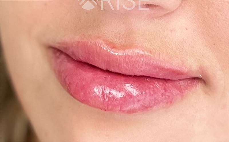Lip Filler Before & After