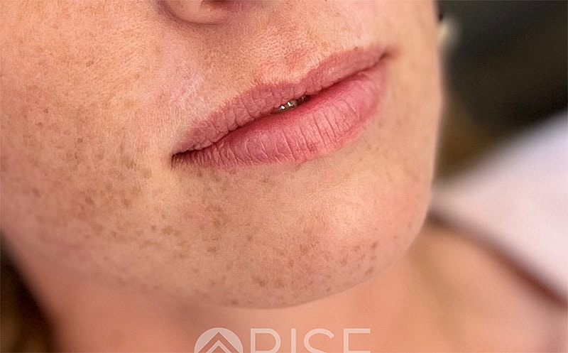 Lip Filler Before & After