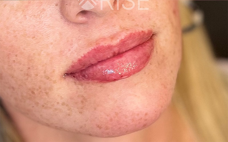 Lip Filler Before & After