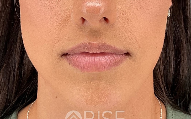 Lip Filler Before & After