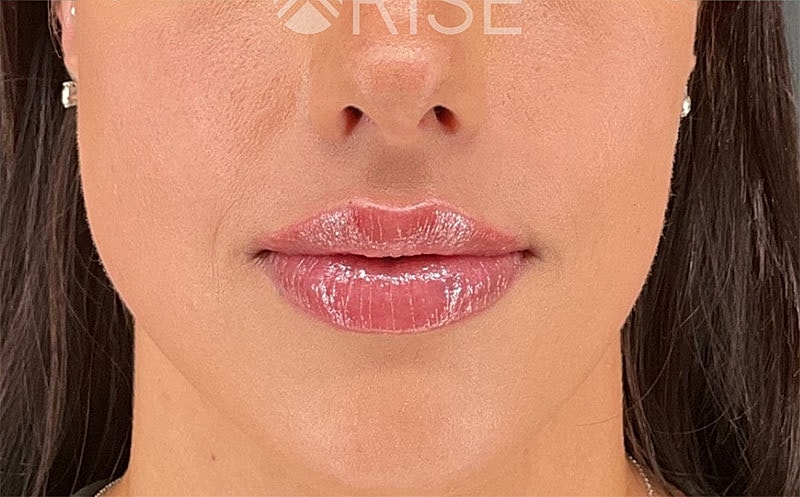 Lip Filler Before & After