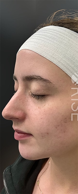 Lip Filler Before & After