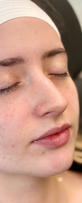 Lip Filler Before & After