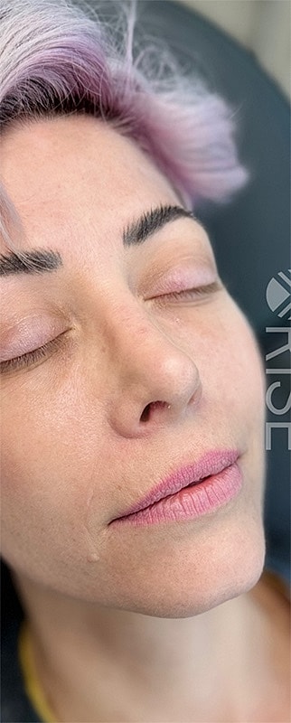 Lip Filler Before & After