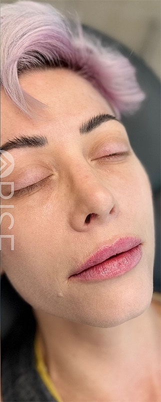 Lip Filler Before & After