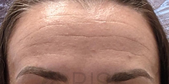 Botox Before & After