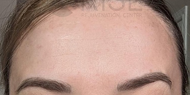 Botox Before & After