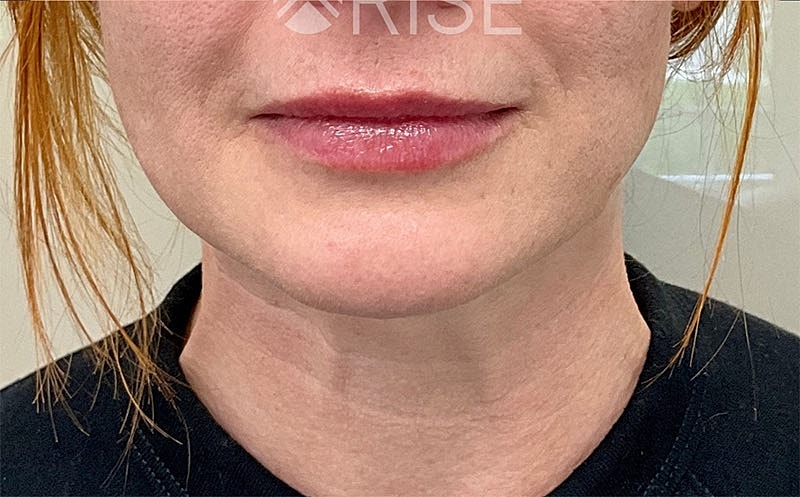 Botox Before & After