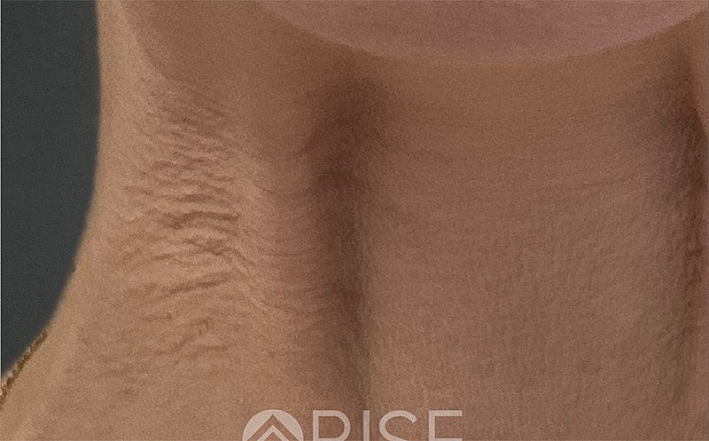 Botox Before & After