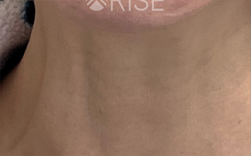 Botox Before & After