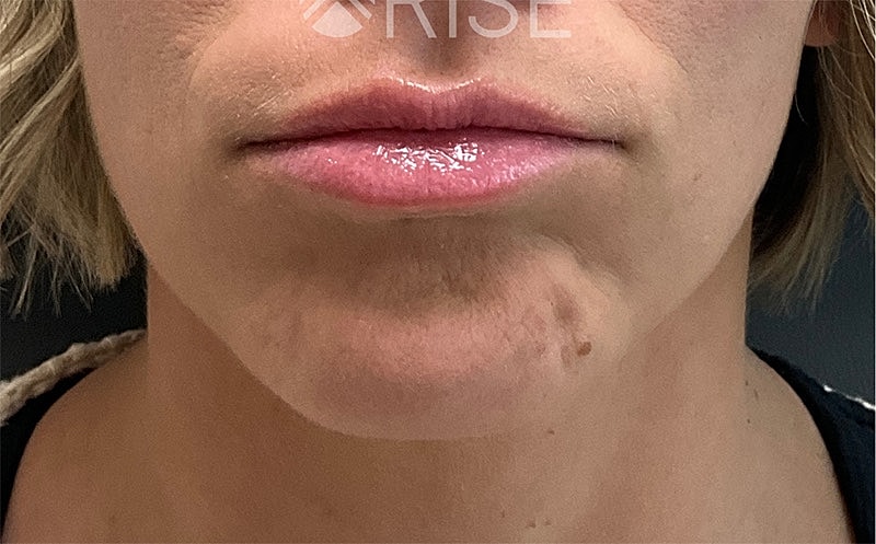 Botox Before & After