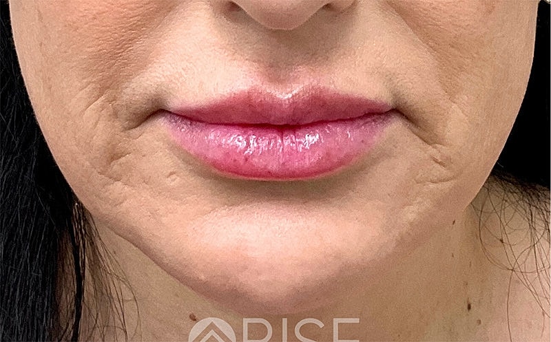 Botox Before & After