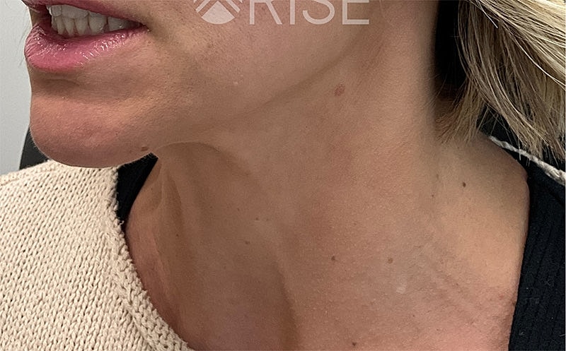 Botox Before & After