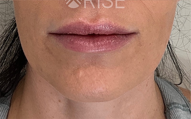 Botox Before & After