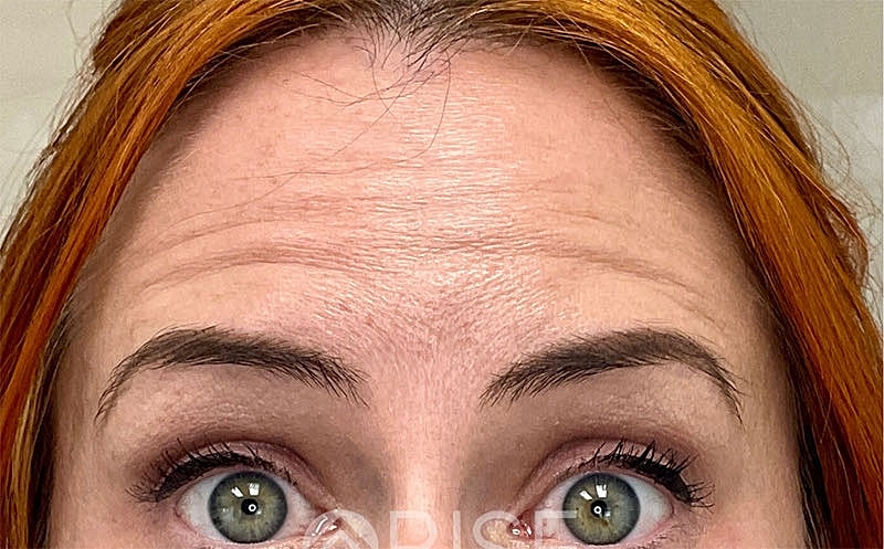 Botox Before & After