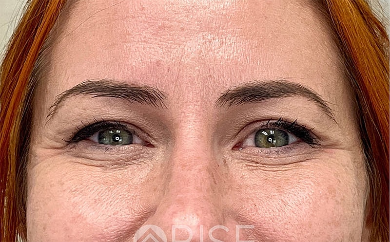 Botox Before & After