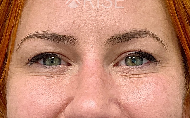 Botox Before & After