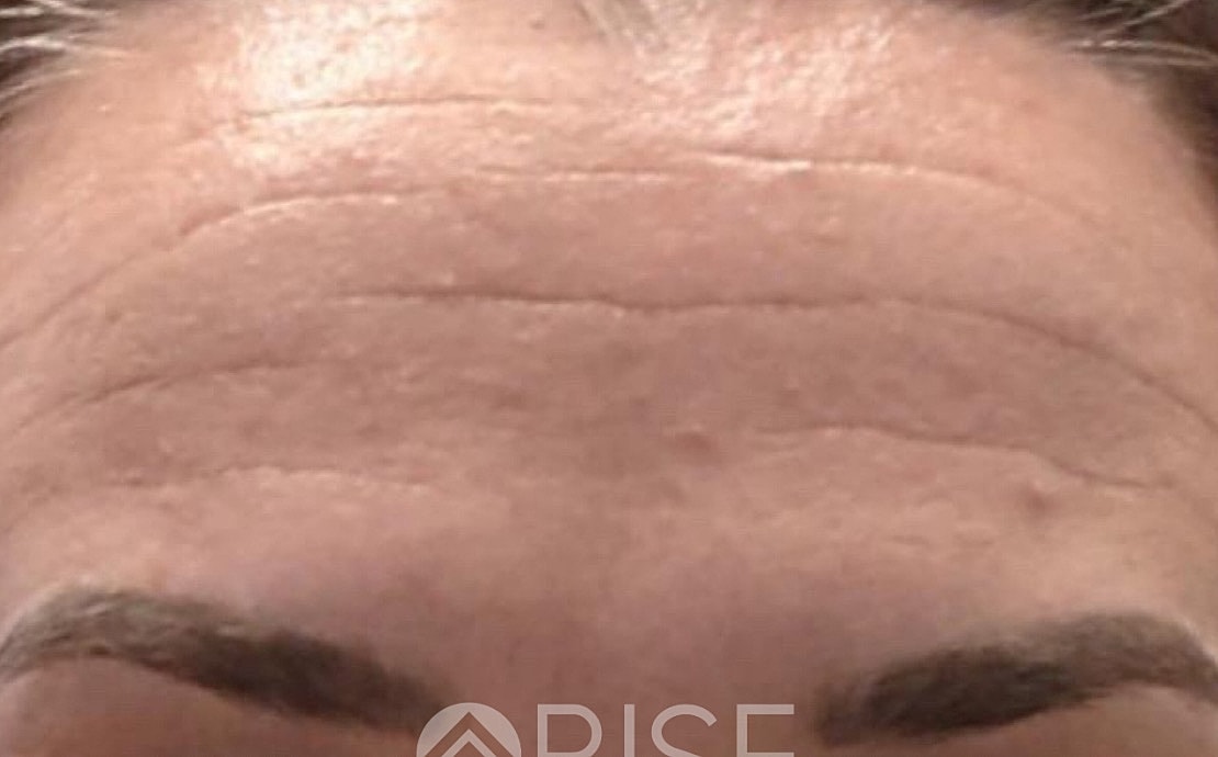 Botox Before & After