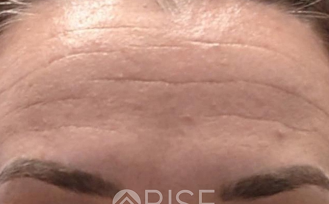 Close-up of a forehead with visible wrinkles.