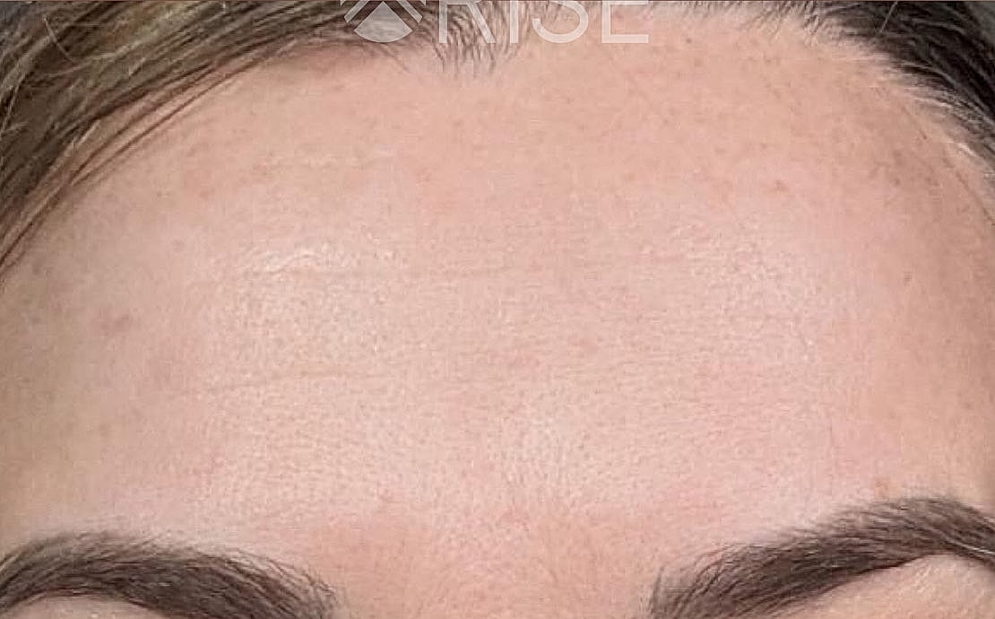 Close-up of a smooth forehead and eyebrows.