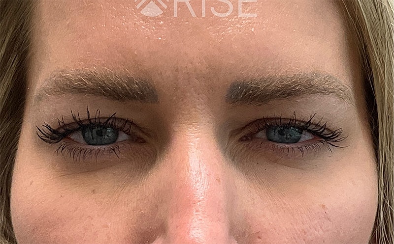 Botox Before & After