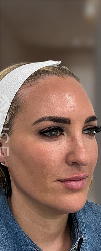 Botox Before & After