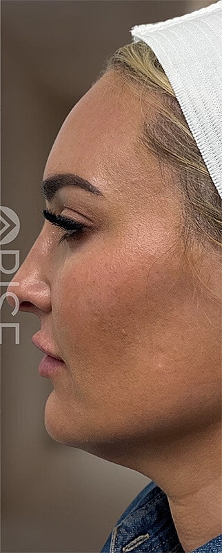 Botox Before & After