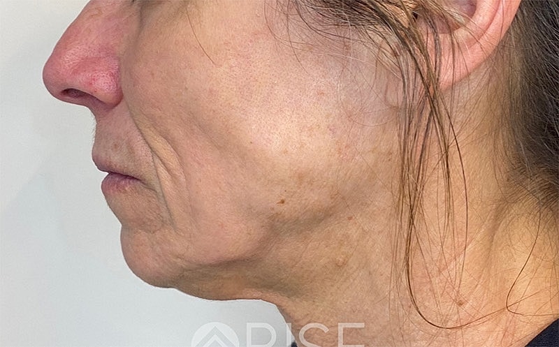 Sculptra Before & After