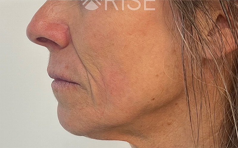 Sculptra Before & After